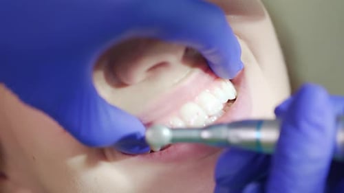 Teeth Polishing Procedure