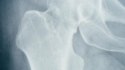 Medical X-Ray Visualization of Human Hip Joint