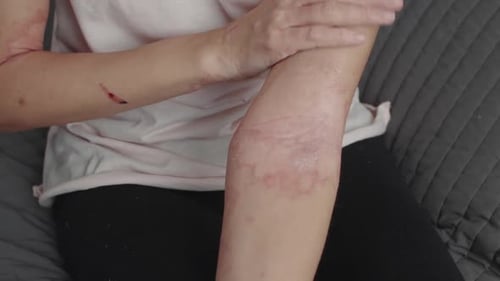 Woman Applies a Harmonious Dermatitis Ointment
