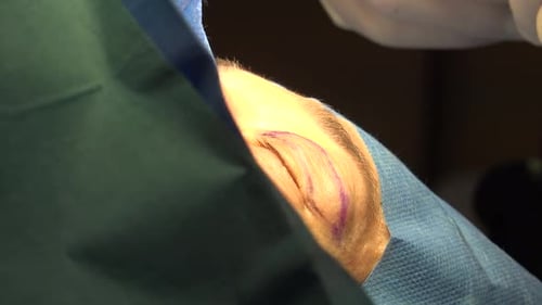 Eyelid Surgery or Blepharoplasty