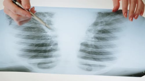 Doctor Analyzing a Chest X-Ray with Metallic Pen