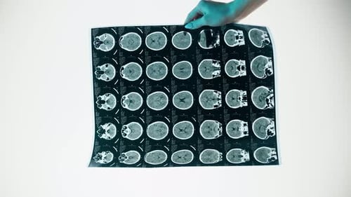 Hand Holds Brain Scan X-Ray Image