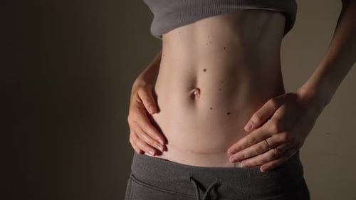 Adult Woman Shows C-Section Scar on Abdomen
