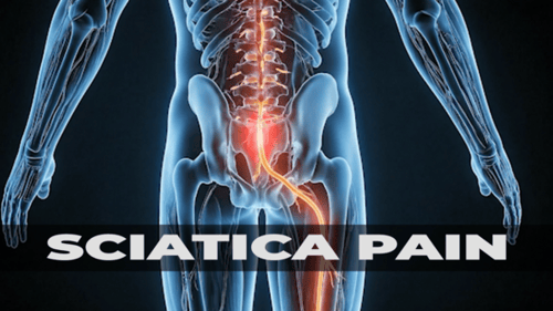 Sciatic Nerve Anatomy Pain Lumbar Spine Animation