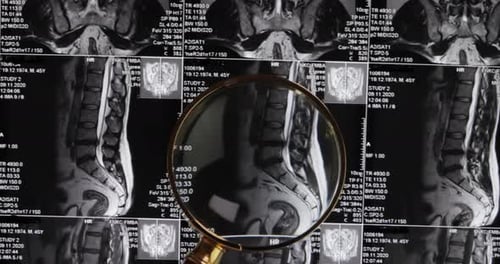 Magnifying Glass Examining Spinal MRI Scans