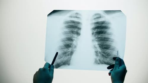 Reviewing an X-Ray Film of Human Lungs