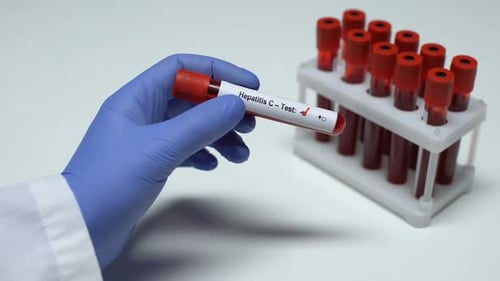 Positive Hepatitis C Blood Test in Lab