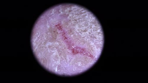 Extreme Close-Up of a Dermal Wound