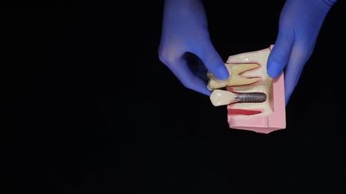 Dental Implant Model With Blue Surgical Glove