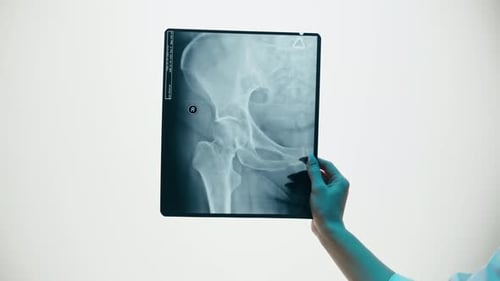 Primer plano de radiografía de cadera pélvica