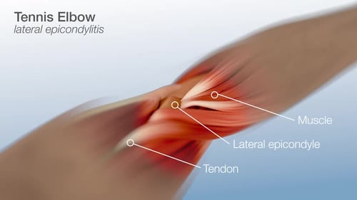 3D Animation of Tennis Elbow Anatomy and Tendon Injury