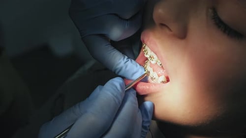 Installation and Fixing of Metal Braces on the Teeth Teen Girl