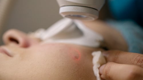 Fractional Skin Laser Treatment