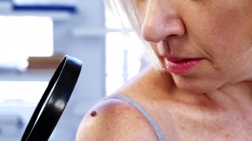 Mole Examined with Magnifying Glass by Doctor