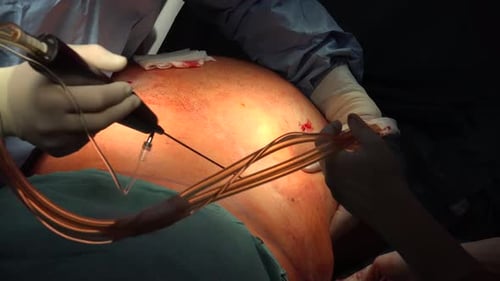 Liposucción y grasa abdominal 9