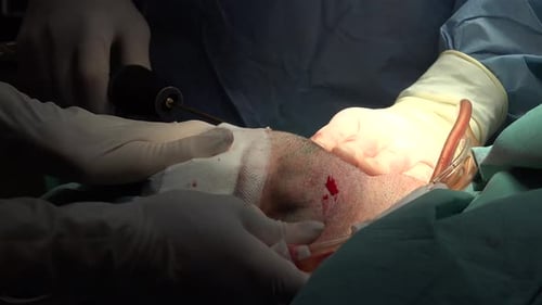 Neck Liposuction For Men 15