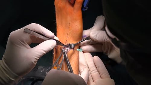 Artroscopia do punho ou disco de fibrocartilagem triangular6