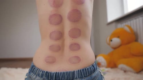 Woman Reveals Back with Bruises After Cupping Therapy