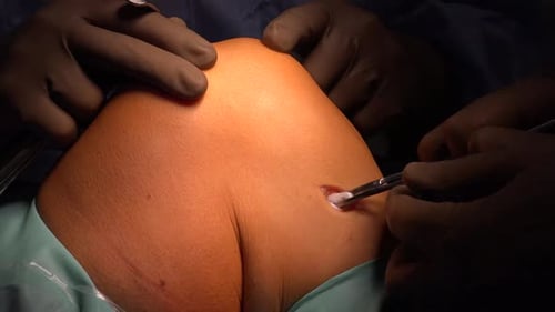 Arthroscopic Knee Surgery with Gloved Hands Close-Up