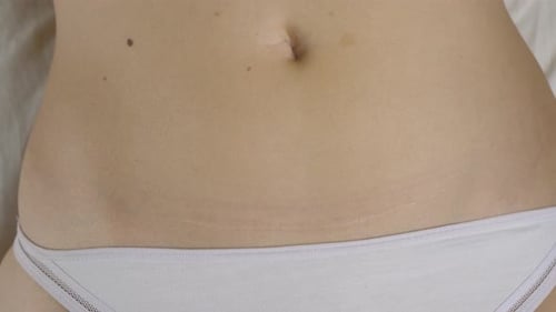 Cicatriz de parto por cesárea
