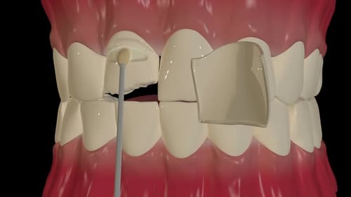 Chipped Tooth Repair Dental Procedure Animation