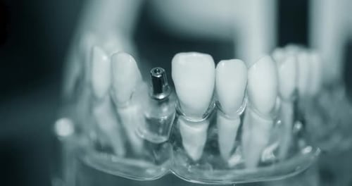 Dental Implant Model Close Up