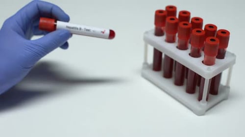 Positive Hepatitis B Test Result in Medical Lab