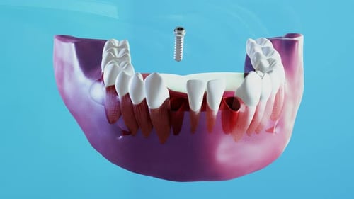 Proceso de implantación dental cerámica