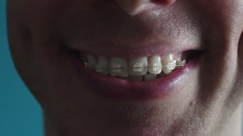 Close Up Happy Man Smile with Dental Braces Close Up