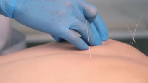 Hands Doctor Akupunkturist führt Akupunkturnadeln in den Rücken der Frau ein