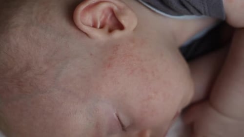 Allergy Atopic Dermatitis Eczema Rash on Baby's Face Cheeks