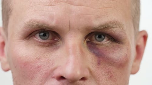 Bluterguss am Auge eines Mannes
