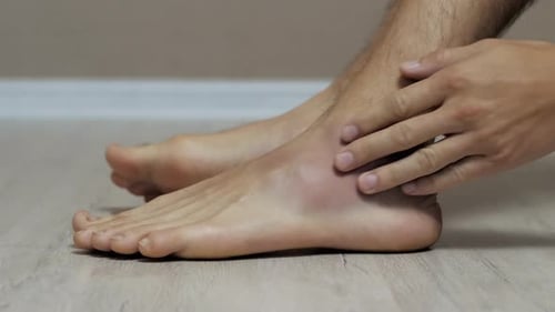 Man Touches His Foot with a Big Bruise Sprain and Injury