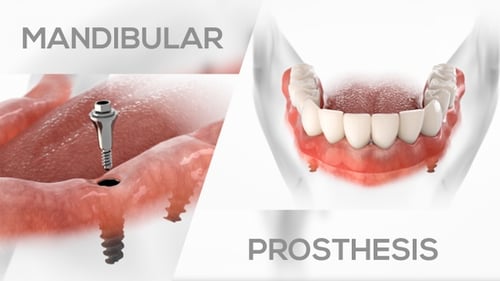 All on Four Dental Implant Procedure and Denture Installation