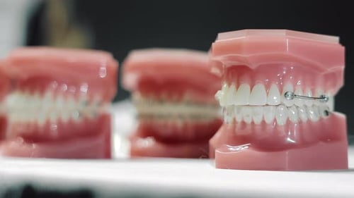 Modelo del espacio entre dientes en la colocación de brackets ortodónticos