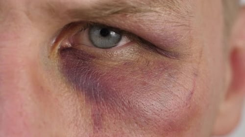 Bluterguss unter dem Auge eines Mannes