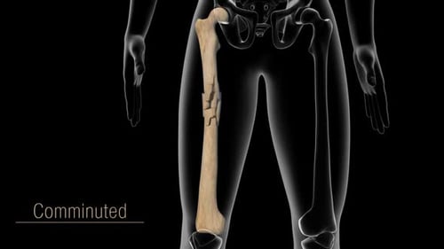 Common Types Of Bone Fractures