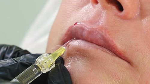 Lip Filler Injection During Cosmetic Medical Procedure