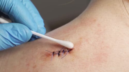 Closeup a Doctor in Medical Sterile Gloves Cotton Swab Treated with Antiseptic Bleeding Wound on the