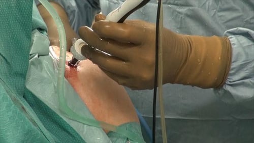 Surgical Procedure Showing Gloved Hand Using Instrument