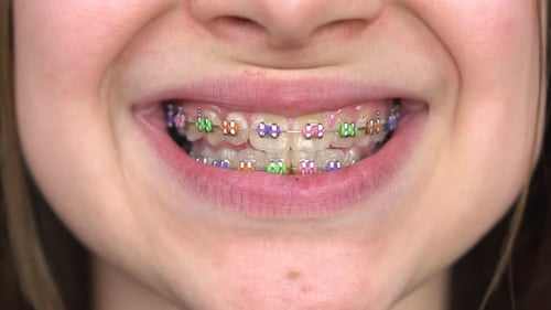 Teen Girl with Braces Smiling Close-up. Girl with Colored Braces on Her Teeth.