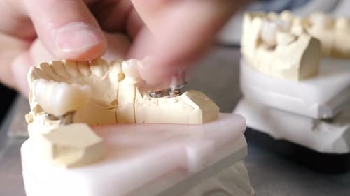 Adding Teeth to a Dental Model