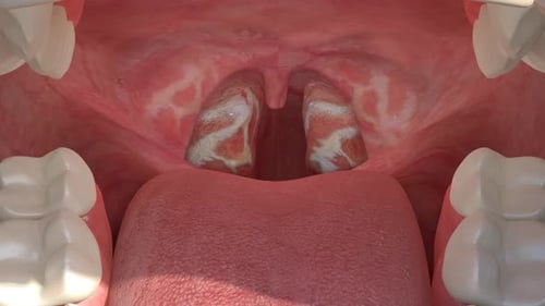 3D Animation of Tonsillitis Developing in Human Mouth
