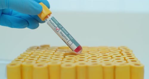 Physician Analysing COVID-19 Disease Positive Blood Test Results, Infectious Disease Specialist with