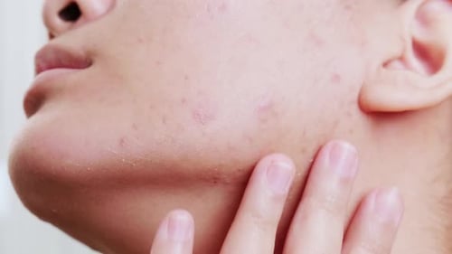 Akne-Haut wegen der Störungen der Talgdrüsenproduktion. Frau zeigt ihre Akne. Hautpflege,