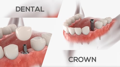 3D Animation of Dental Implant Installation in Human Mouth
