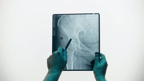 Hands Pointing at Pelvis X-Ray with Pen