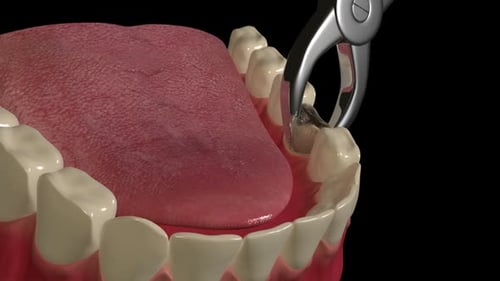 Dental Caries Extraction Medical Procedure Animation