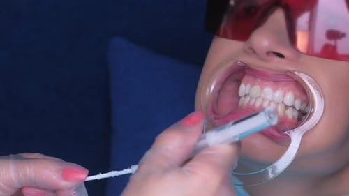 Dental Procedure: Teeth Whitening Treatment Close Up