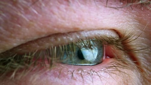 Élargissement de l'iris oculaire